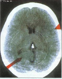 Radiografía cerebral.